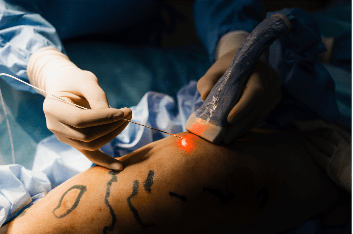 Laser endoveineux