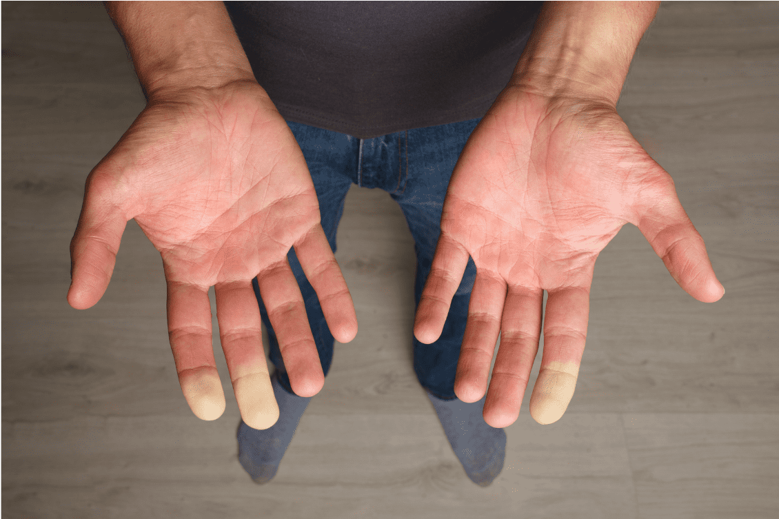 Phénomène de Raynaud