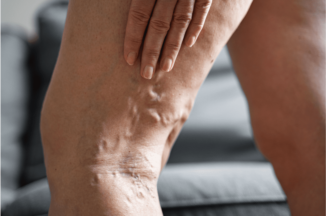 Varices