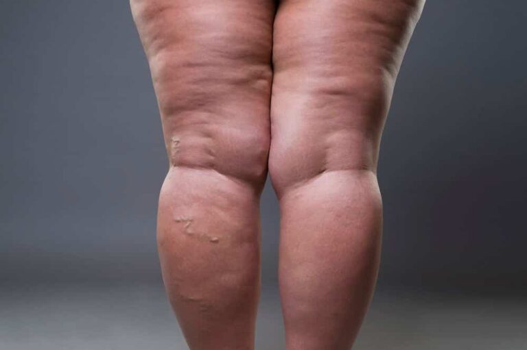lipoedème